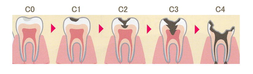 虫歯の進行